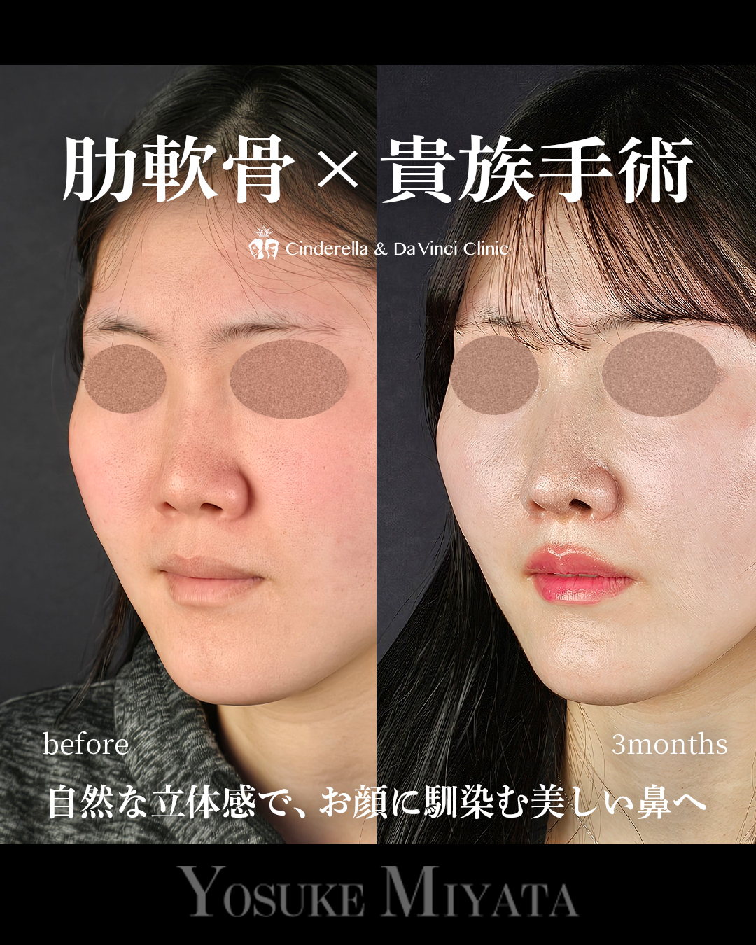 小鼻を小さく見せるの画像
