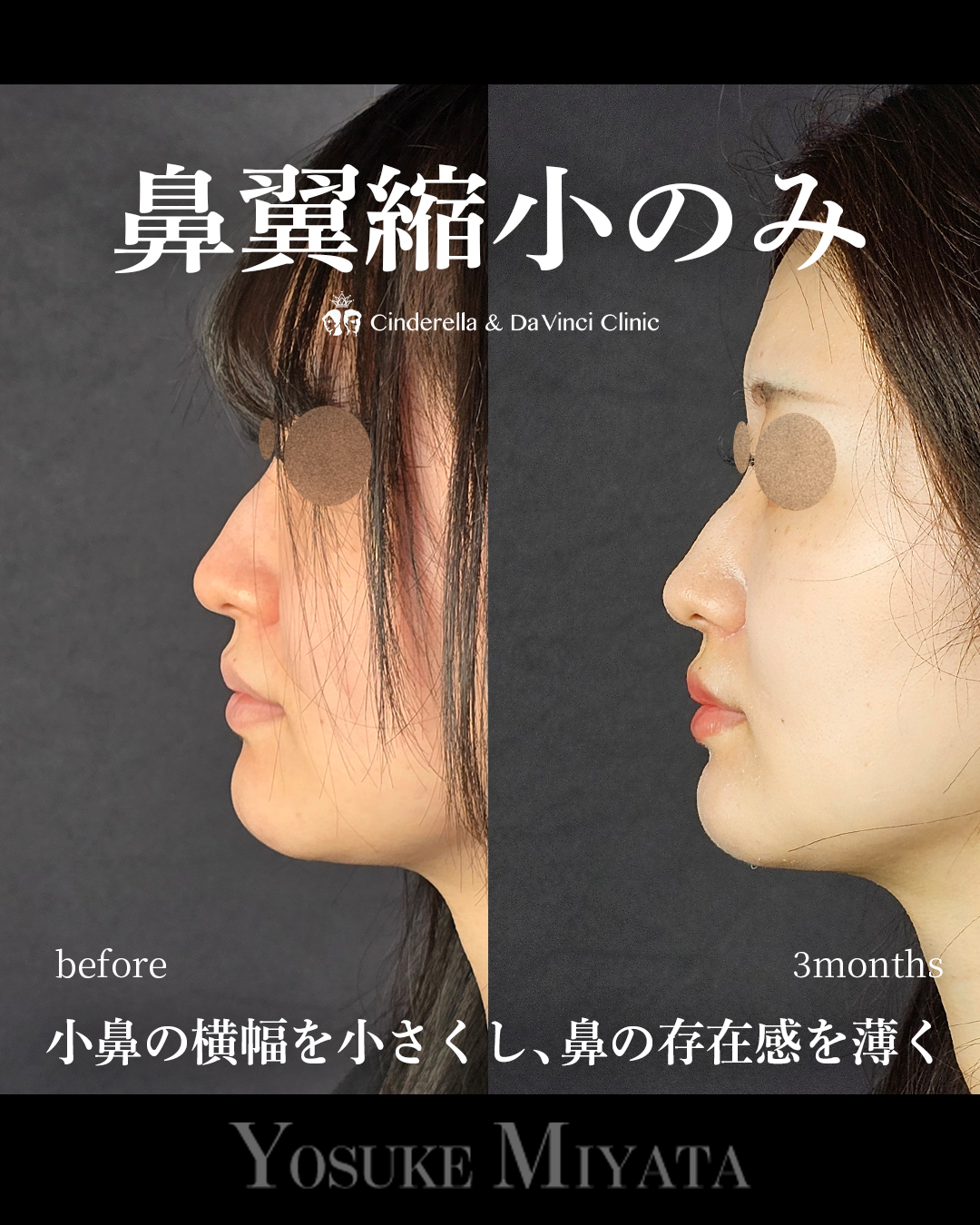 小鼻縮小のみで鼻の存在感をなくすの画像