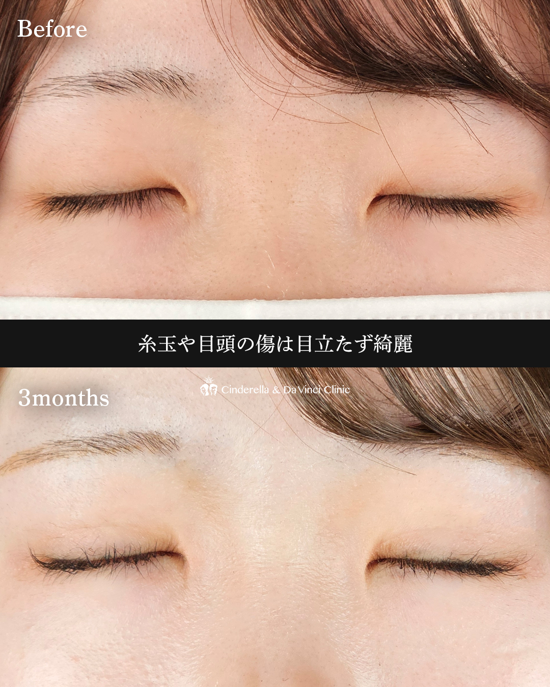 理想のMix型への画像