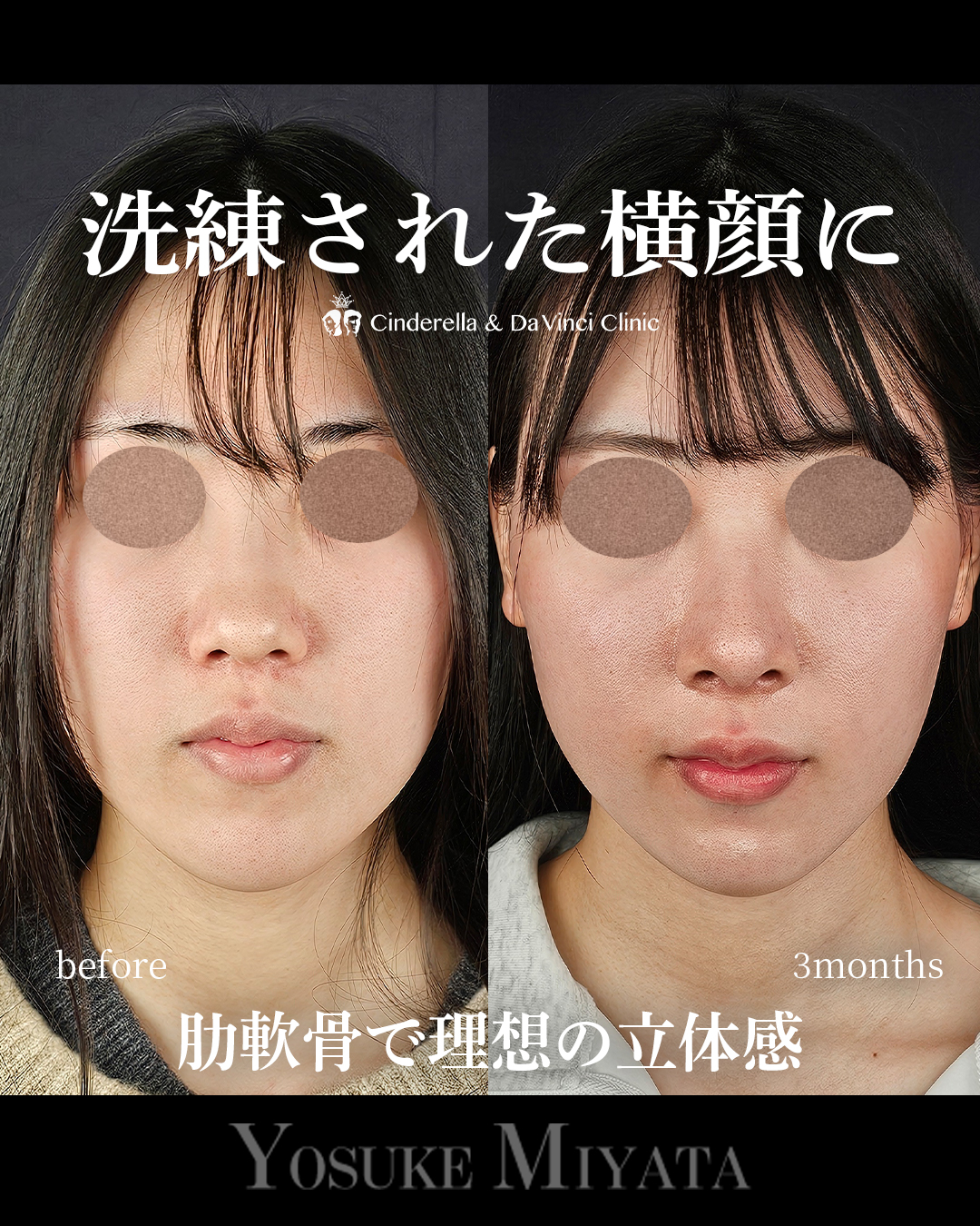 鼻整形で横顔をきれいにするの画像