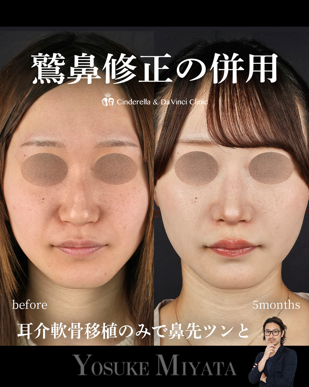 鷲鼻修正の併用の画像
