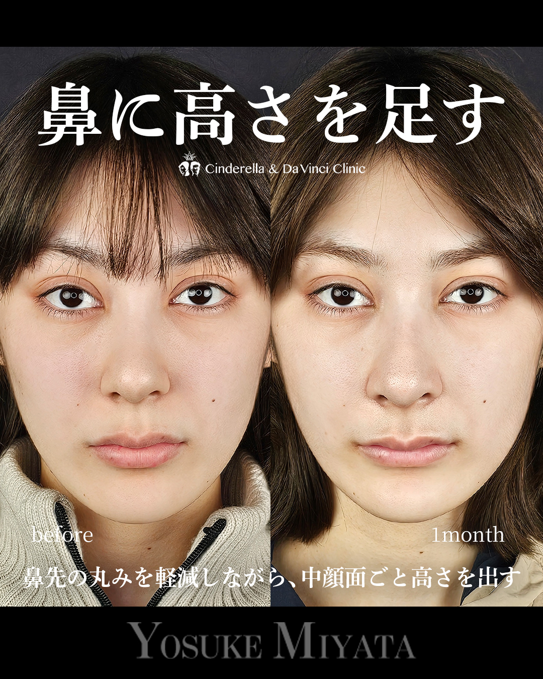 鼻に高さを足すの画像