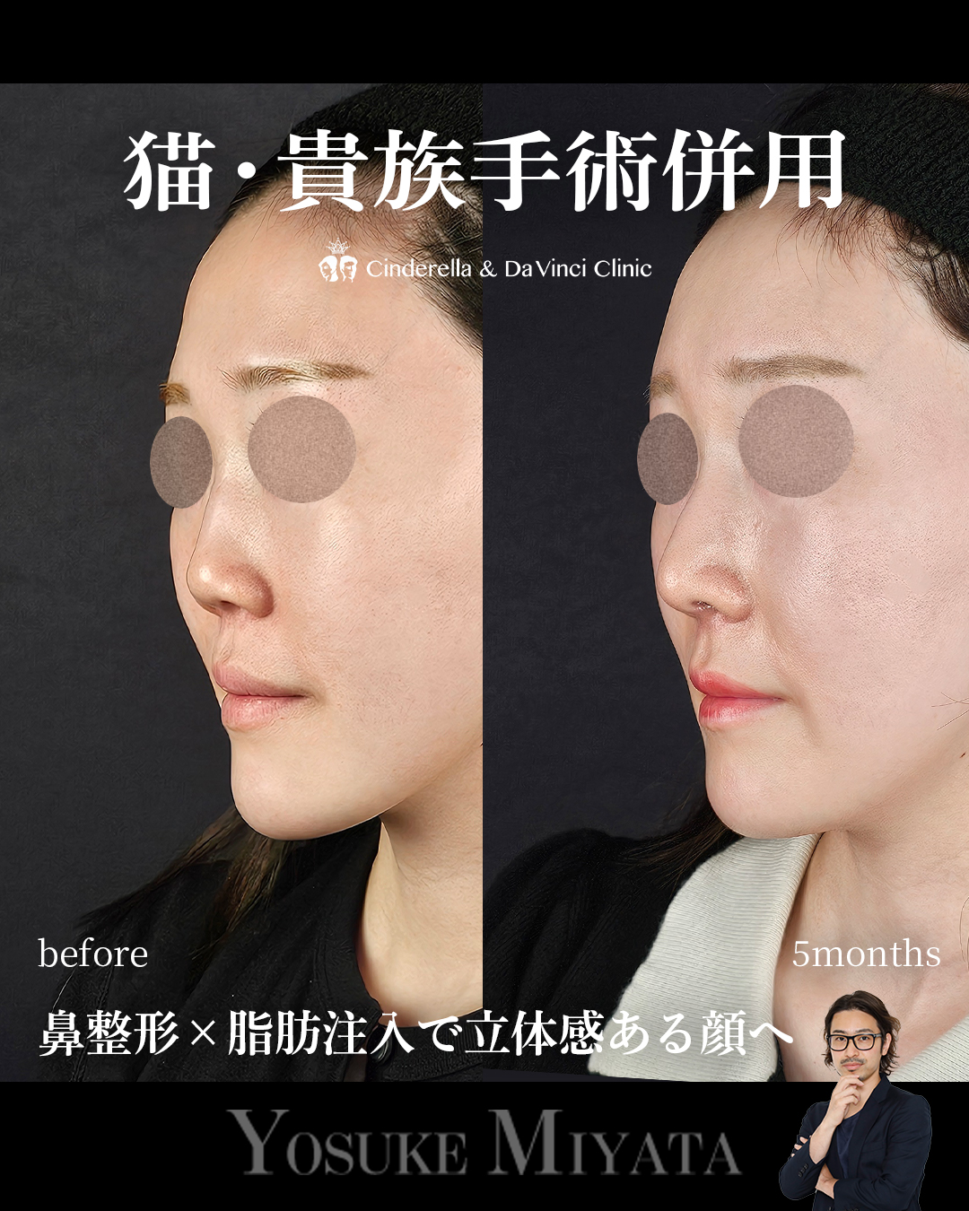 顔に立体感を出すの画像