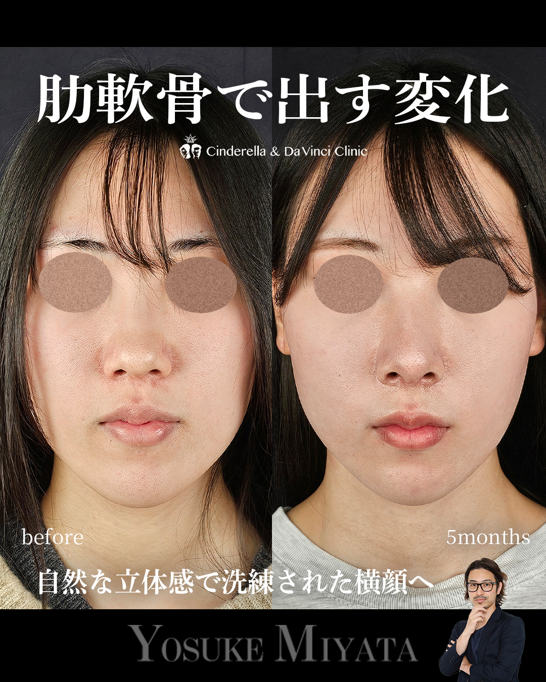 鼻整形で横顔をきれいにするの画像