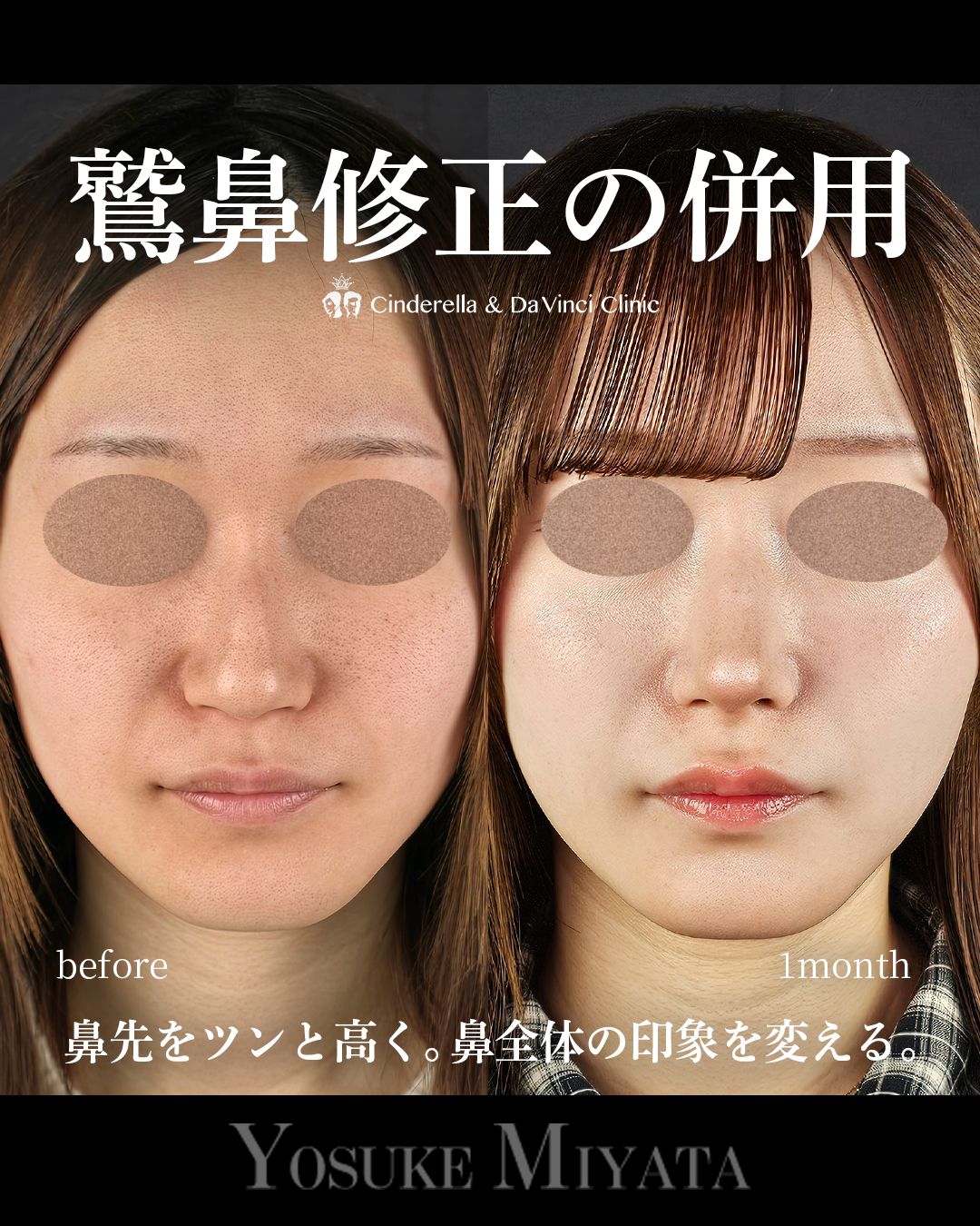 鷲鼻修正の併用の画像