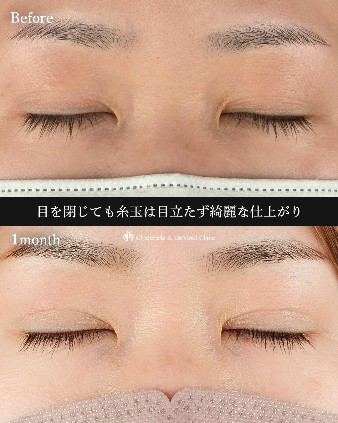 左右差の無い二重の画像