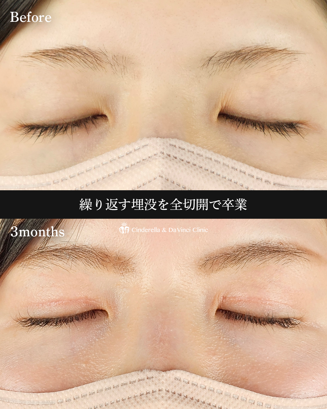 埋没から全切開への画像