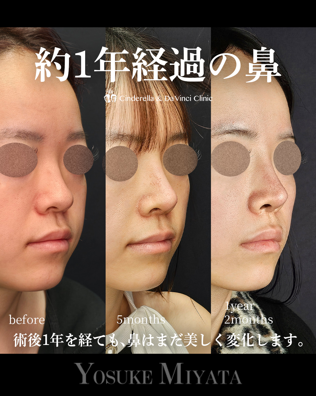 1年2ヶ月経過の鼻の画像