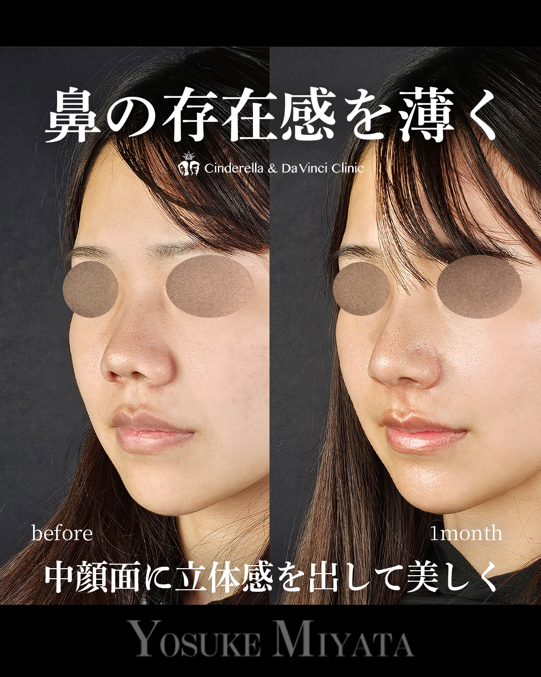 鼻の存在感を薄くの画像