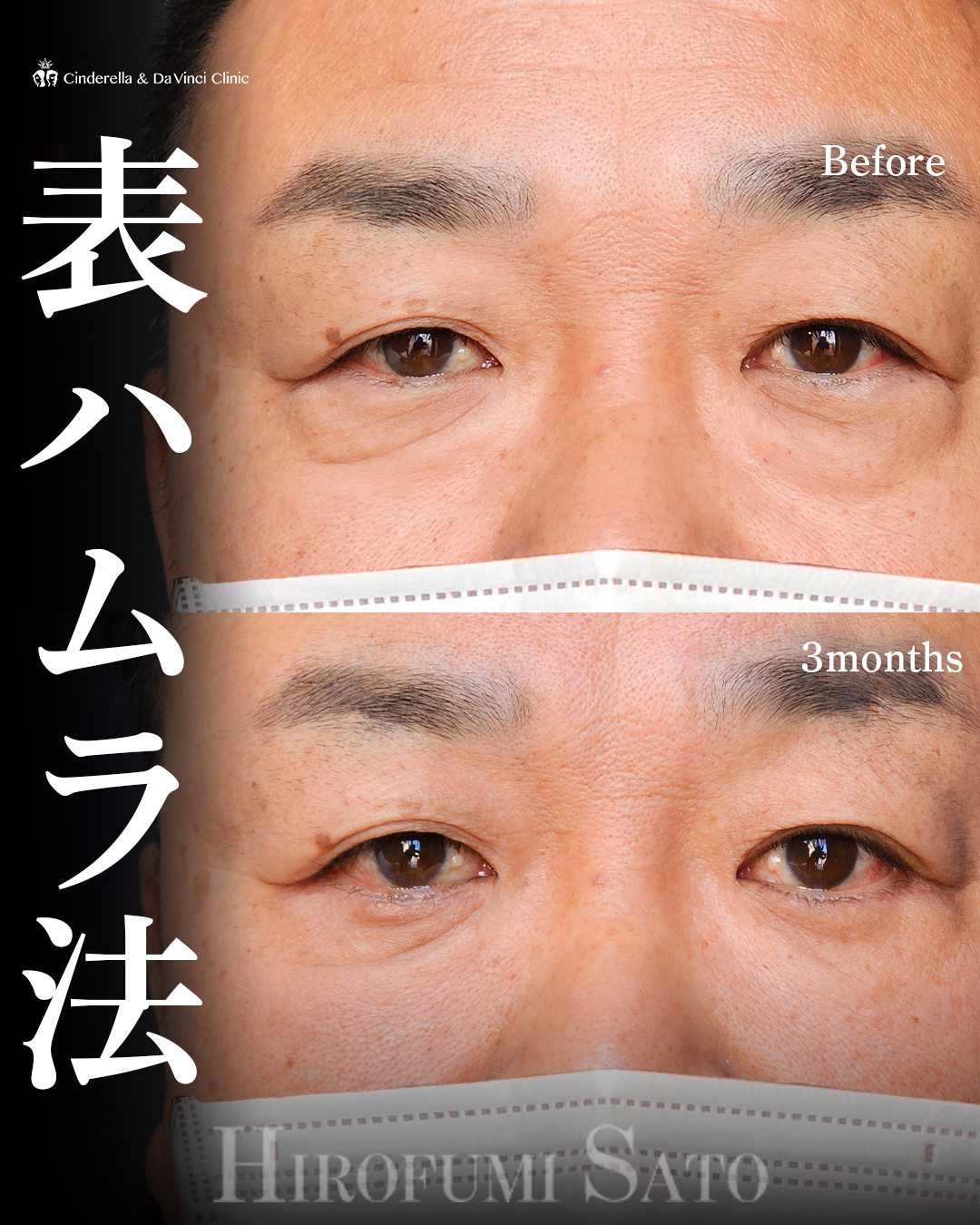 表ハムラでクマ解消