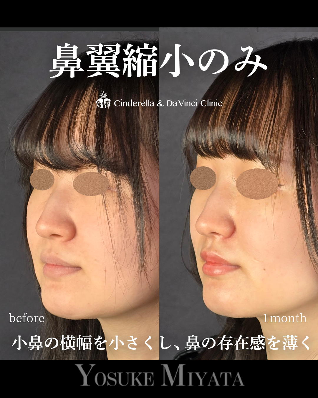 小鼻縮小のみで鼻の存在感をなくすの画像