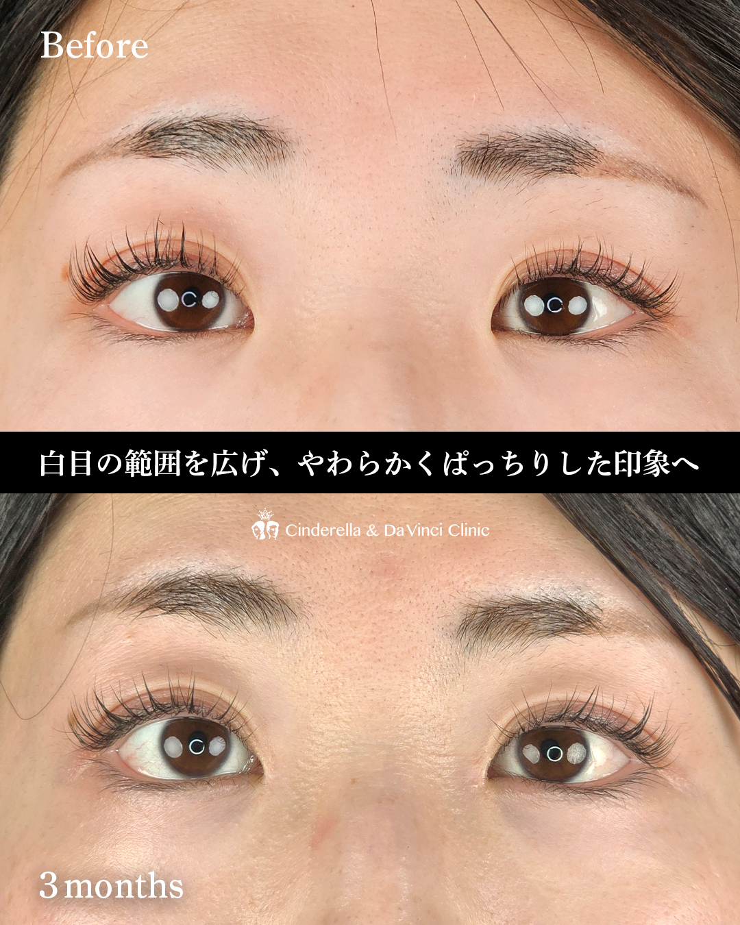 目頭切開とタレ目同時の画像
