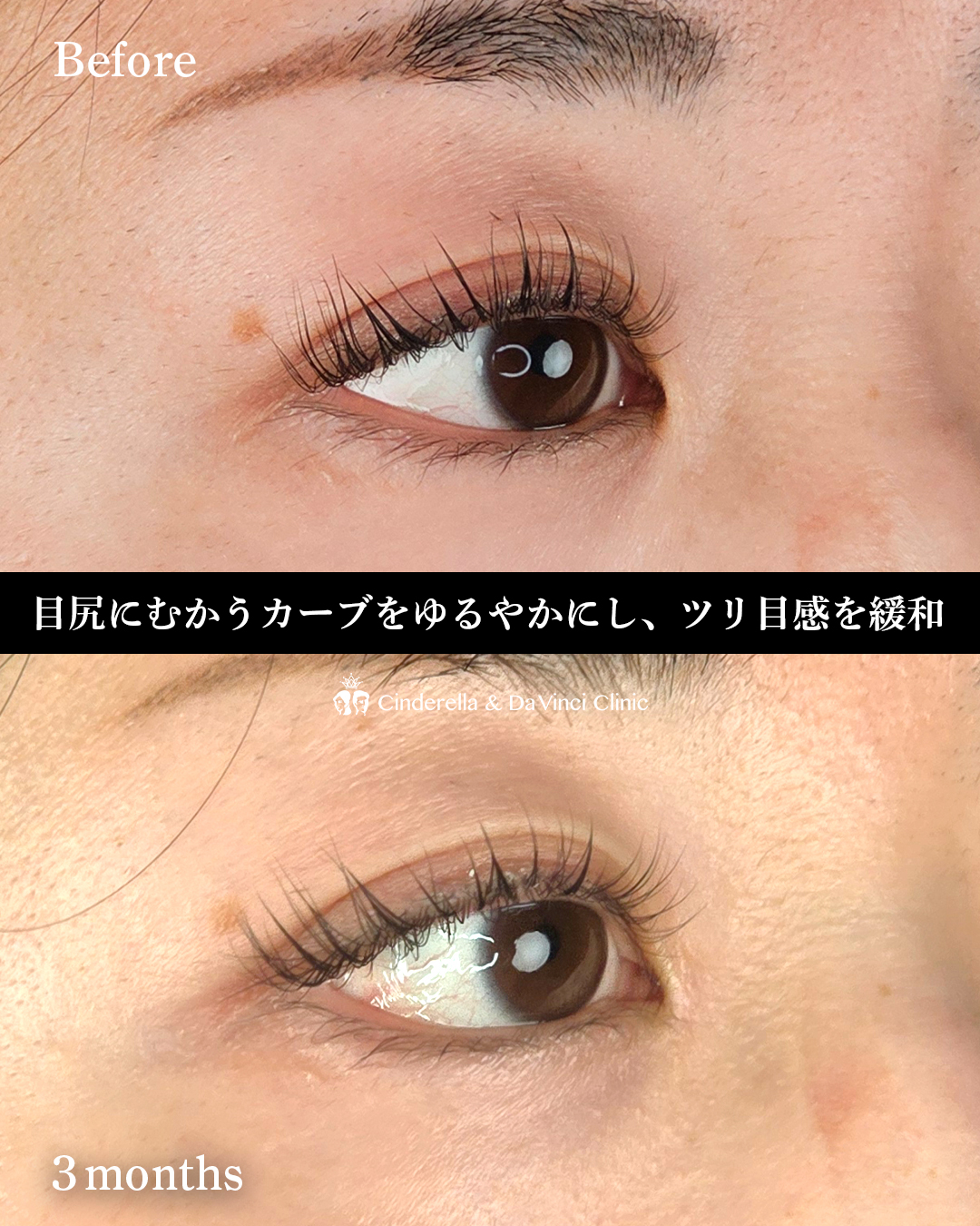 目頭切開とタレ目同時の画像