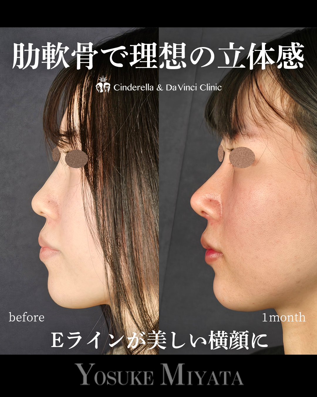 鼻整形で横顔をきれいにする