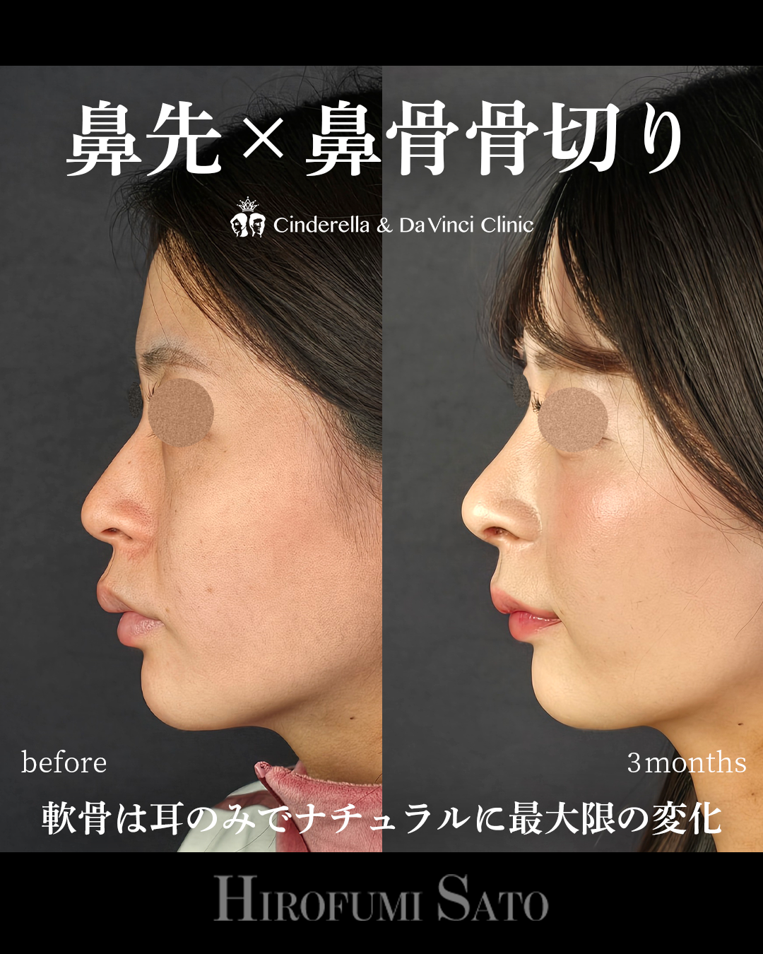 ナチュラルな鼻整形の画像
