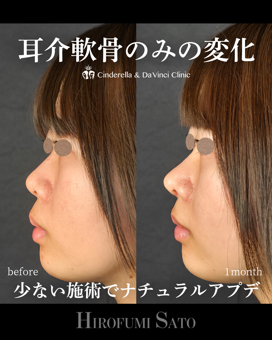 少ない施術でナチュラルアプデ