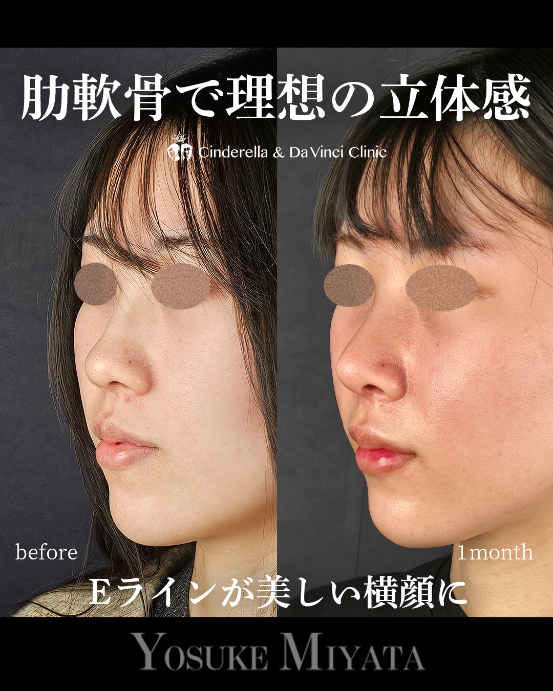 鼻整形で横顔をきれいにするの画像