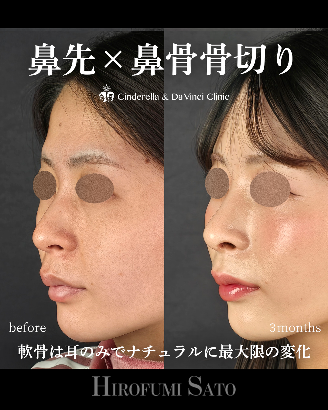 ナチュラルな鼻整形の画像