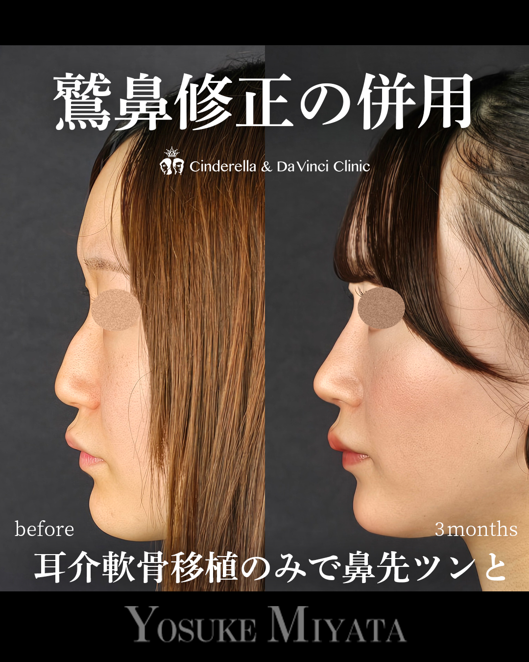 鷲鼻修正の併用の画像