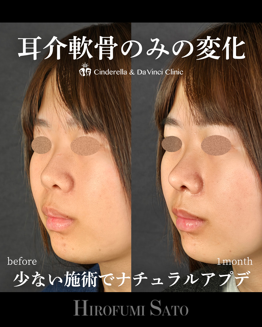 少ない施術でナチュラルアプデの画像