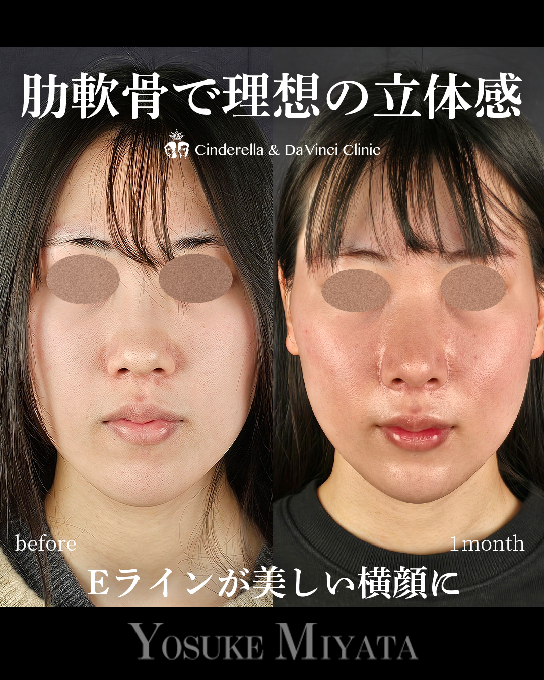 鼻整形で横顔をきれいにするの画像