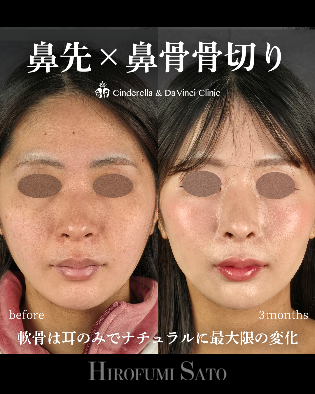 ナチュラルな鼻整形の画像
