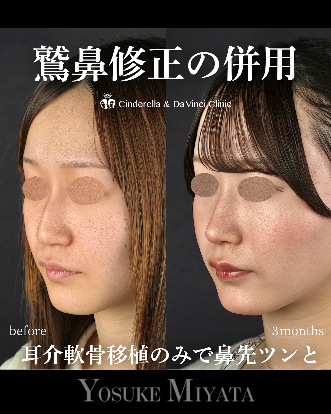 鷲鼻修正の併用の画像
