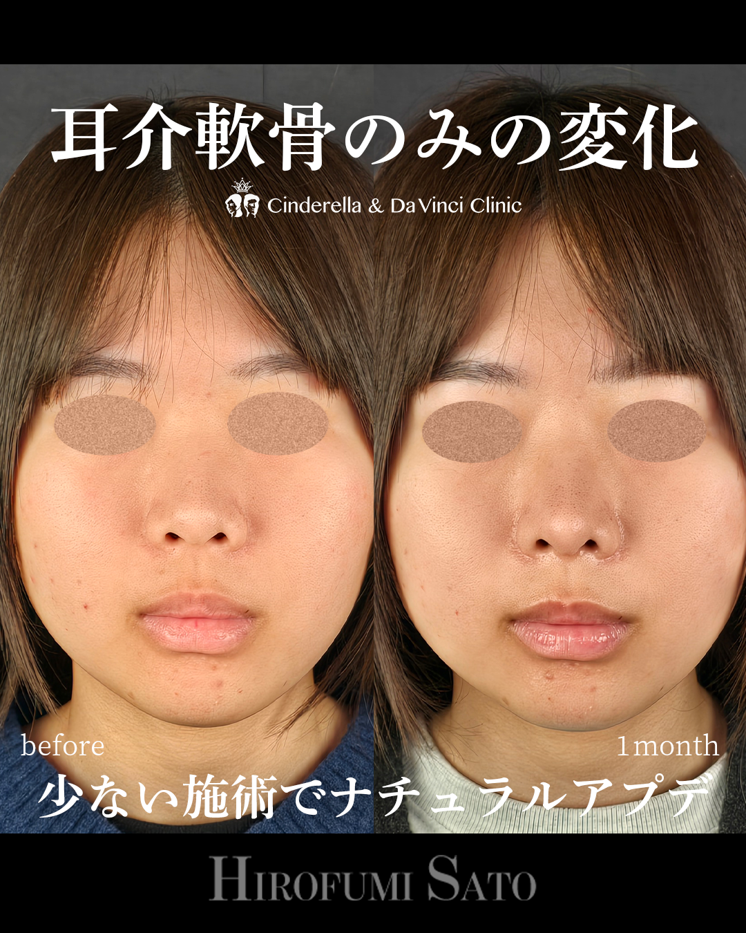 少ない施術でナチュラルアプデの画像