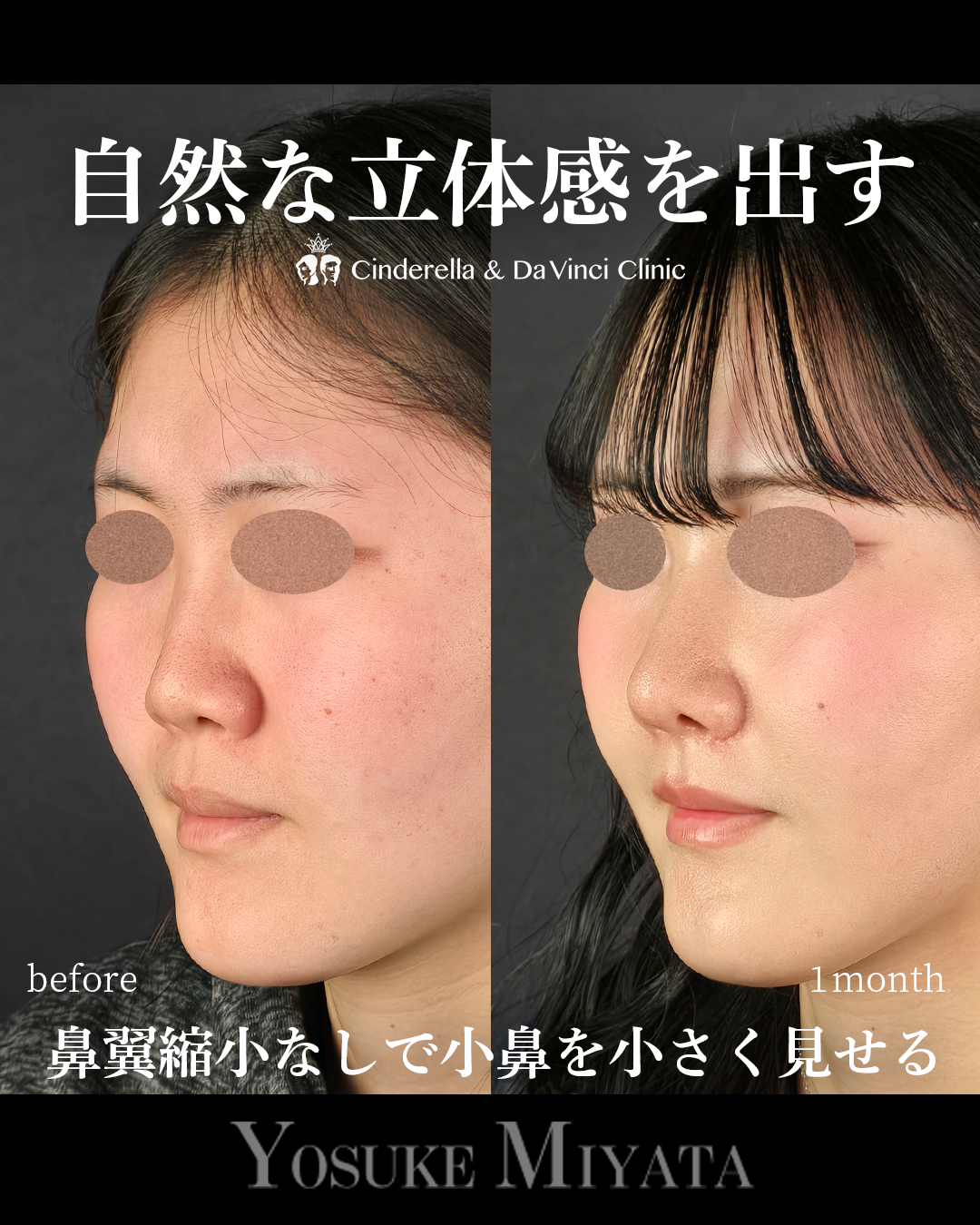 小鼻を小さく見せるの画像