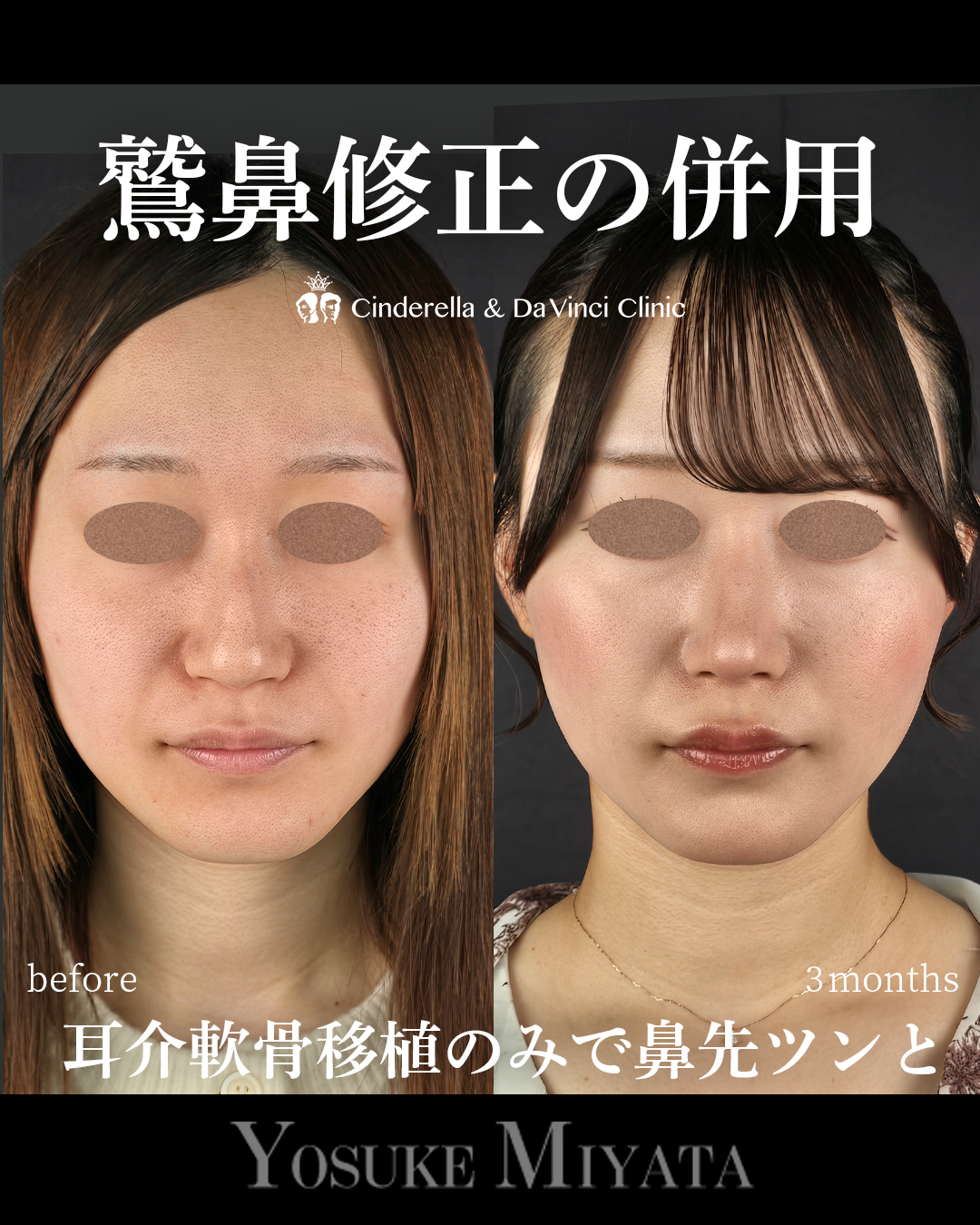 鷲鼻修正の併用の画像