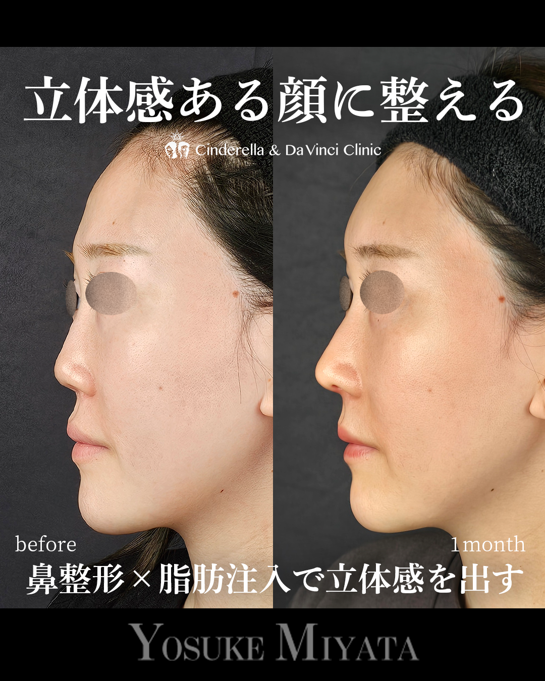 顔に立体感を出す