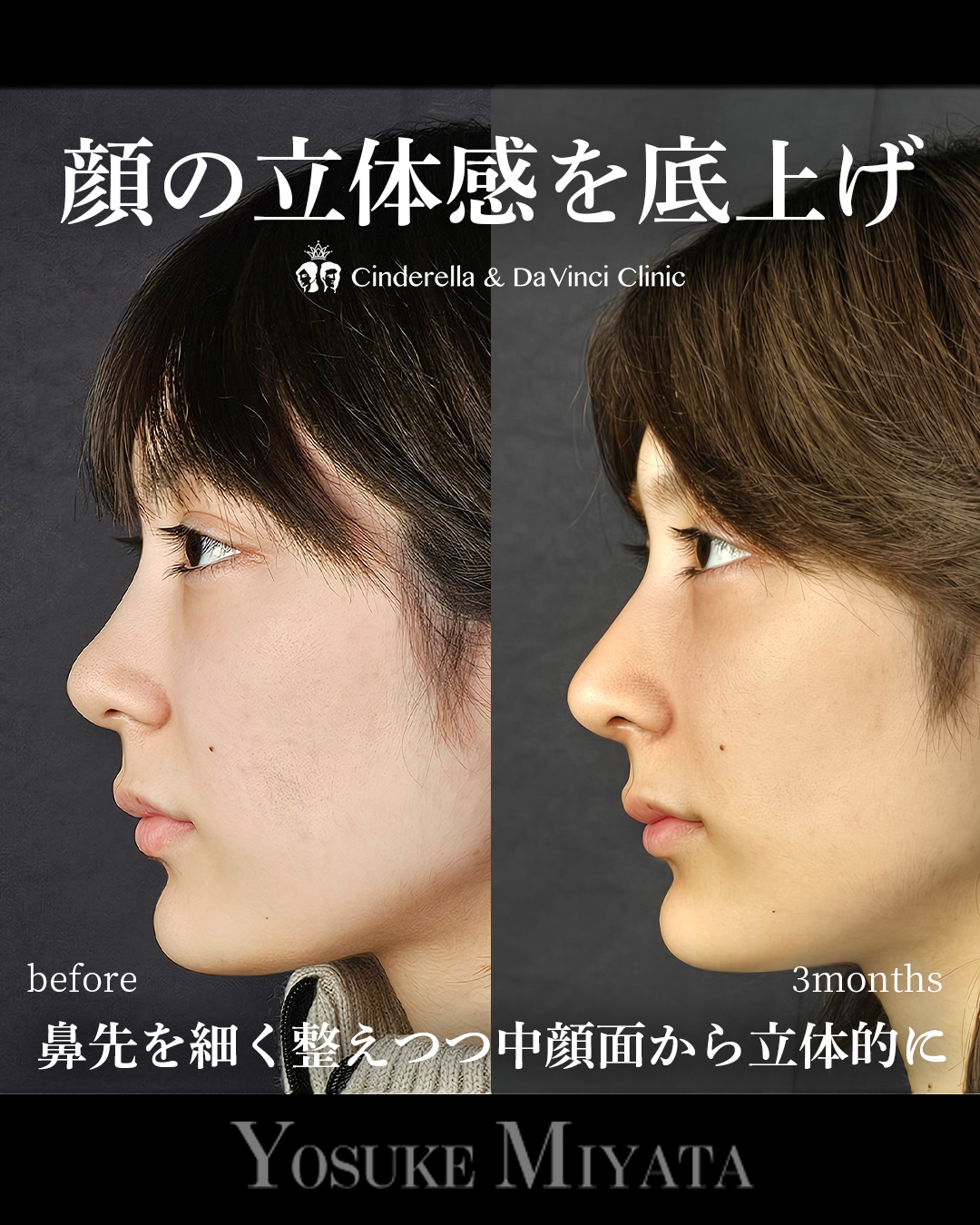 鼻に高さを足す