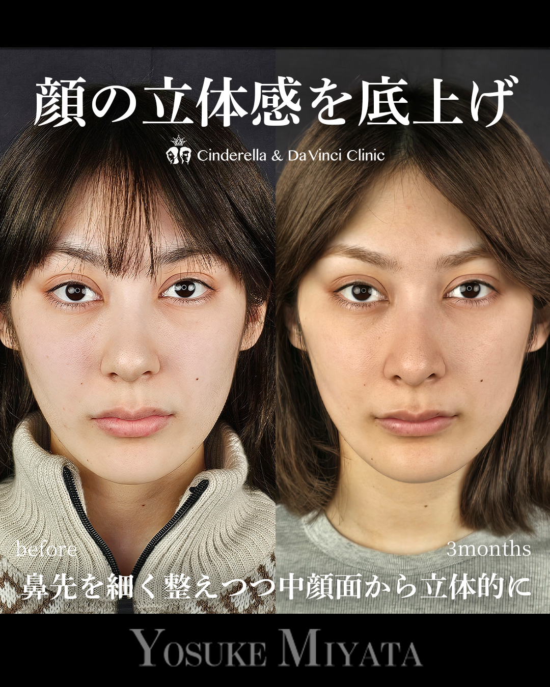 鼻に高さを足すの画像