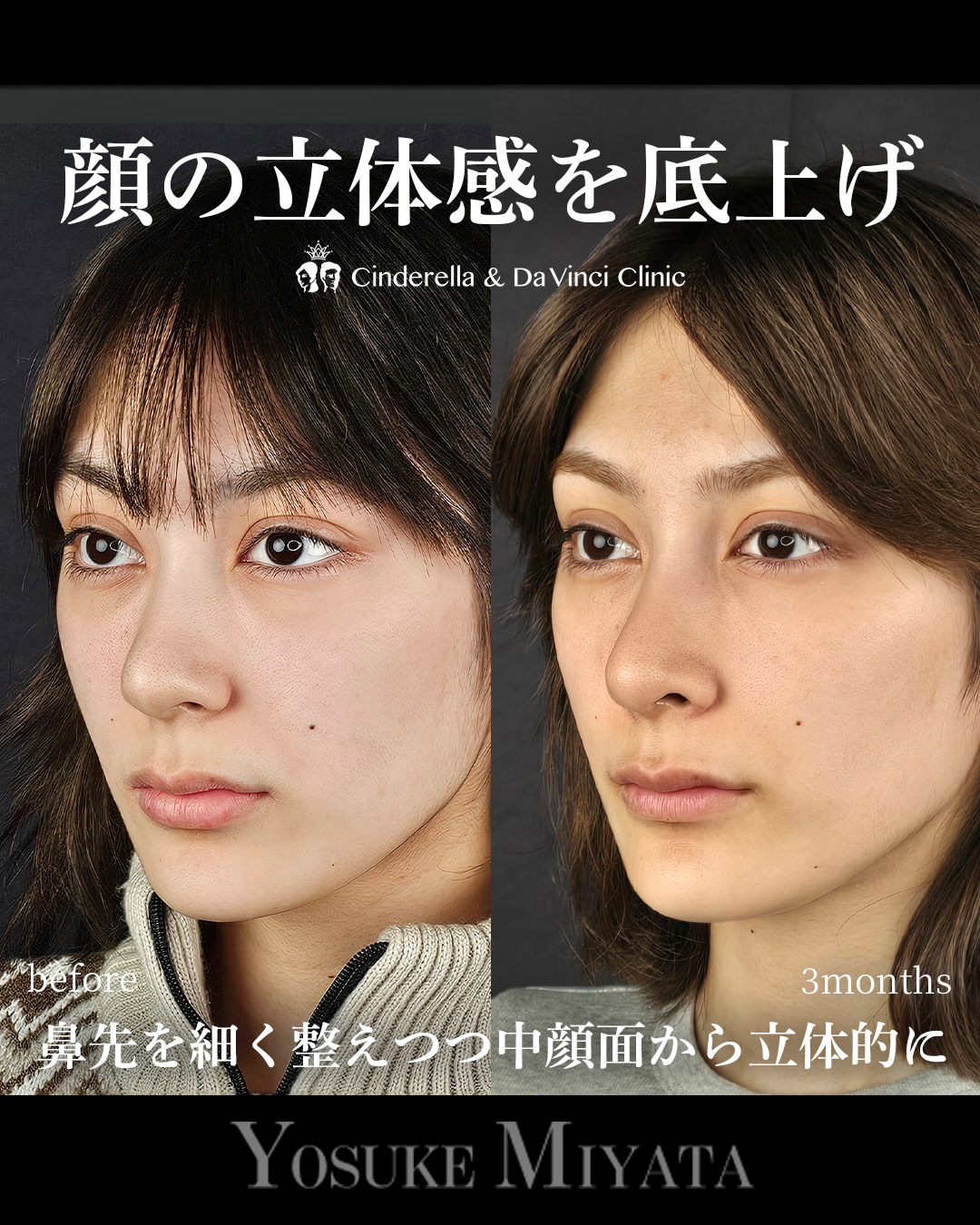 鼻に高さを足すの画像