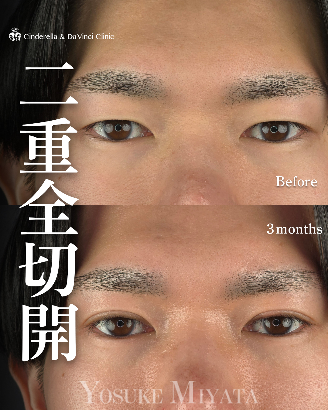 男性の二重切開