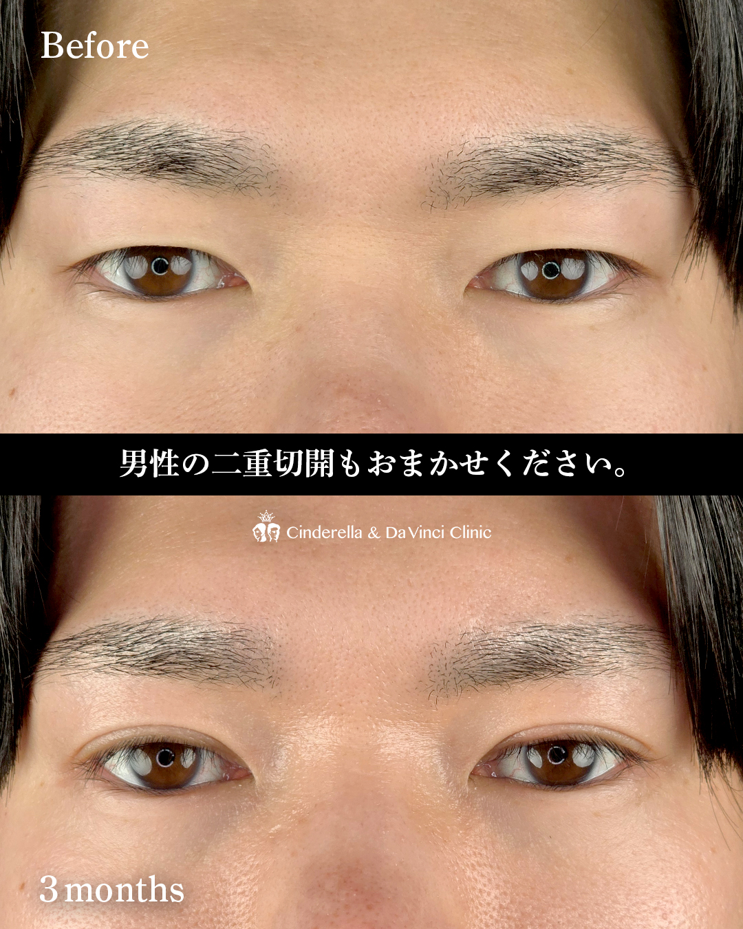 男性の二重切開の画像