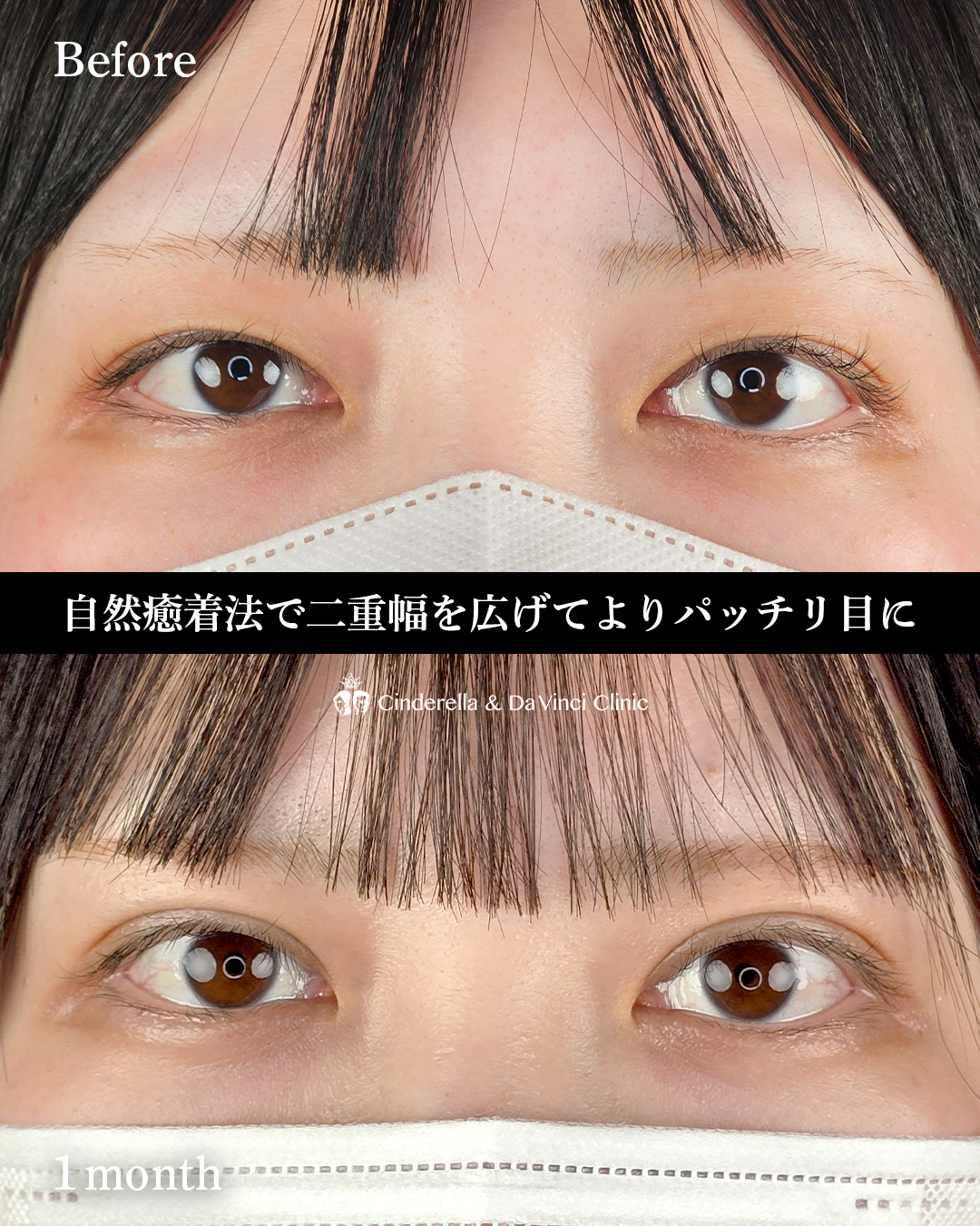 埋没で二重幅を少し広げるの画像