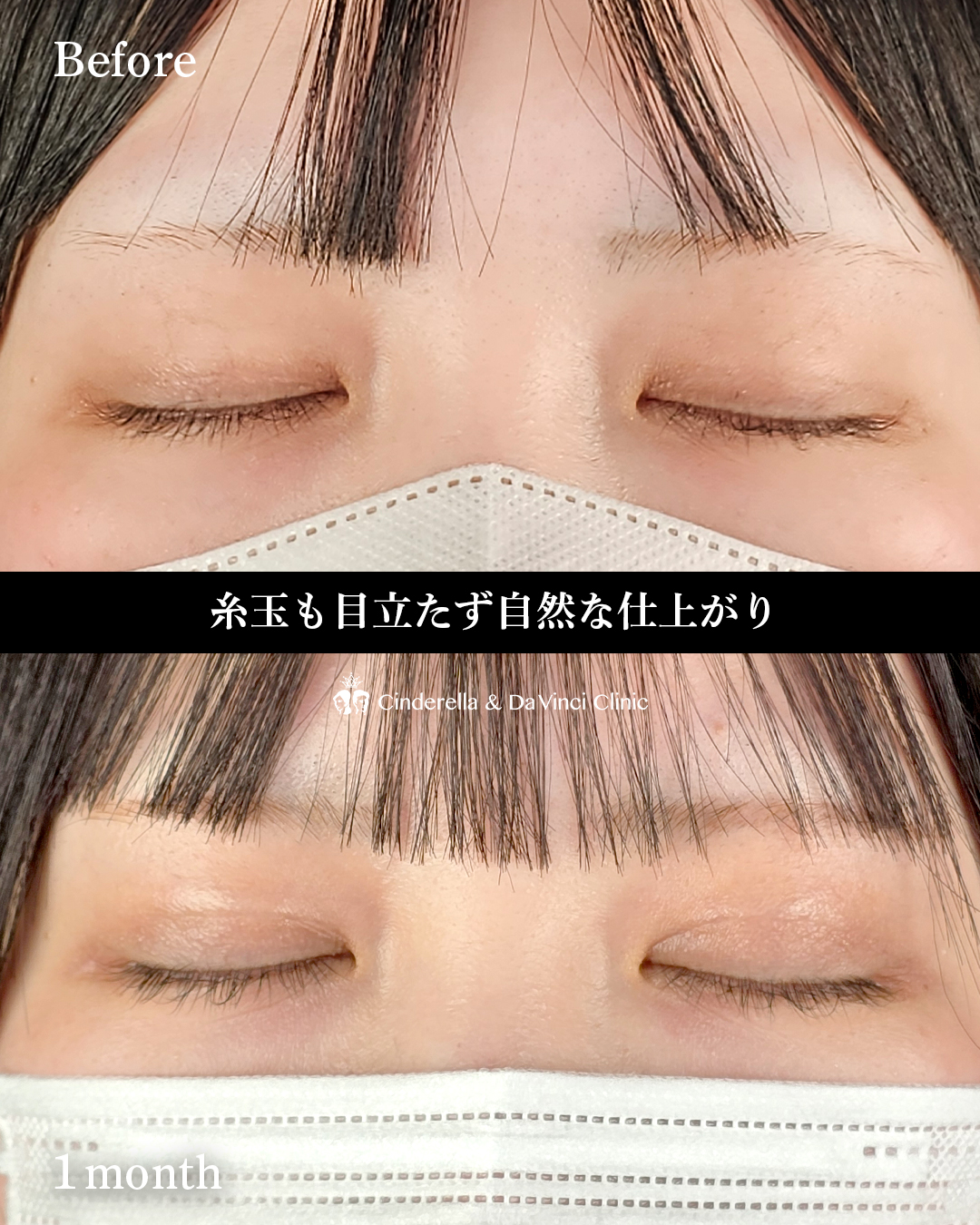 埋没で二重幅を少し広げるの画像