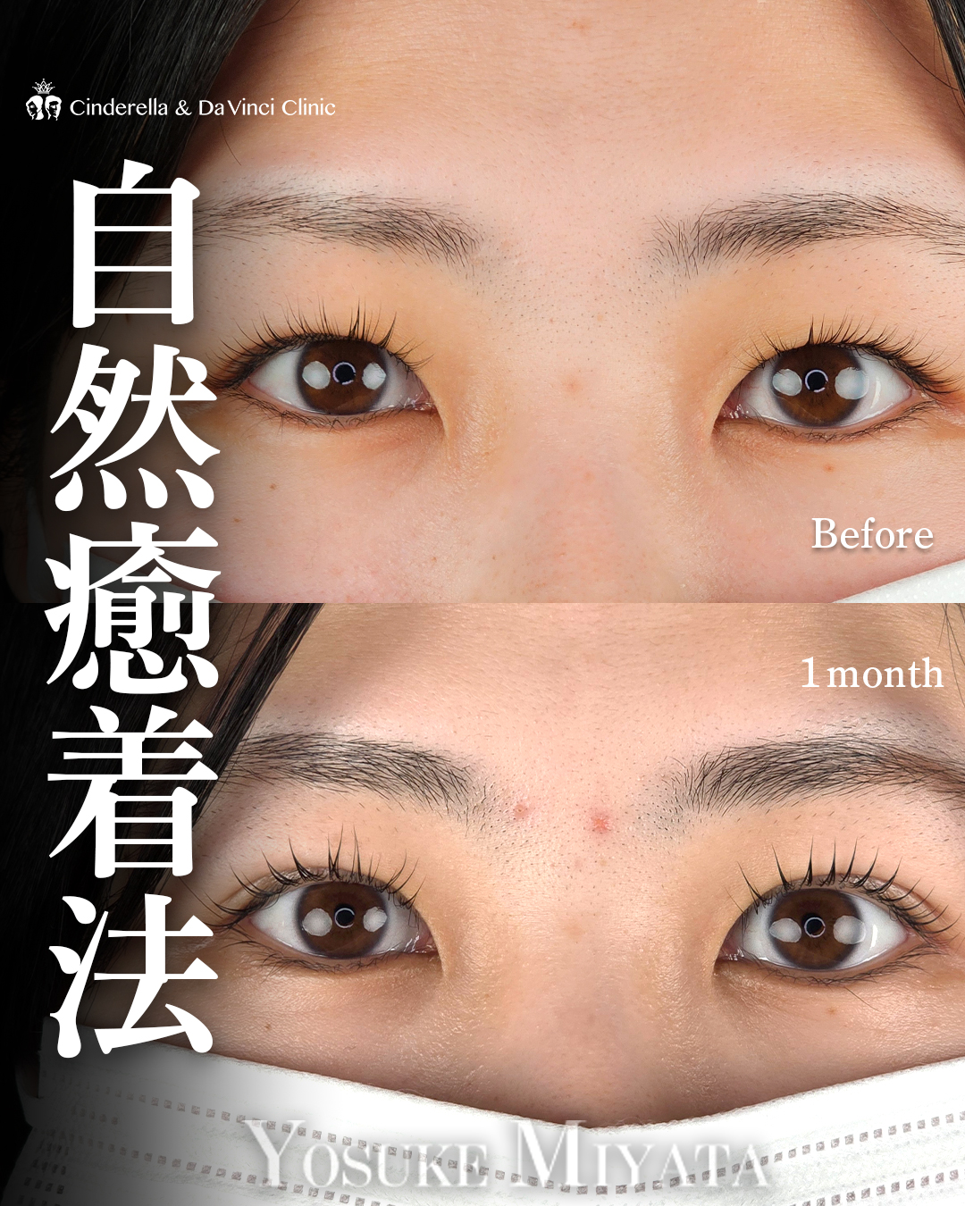 末広二重でもぱっちり