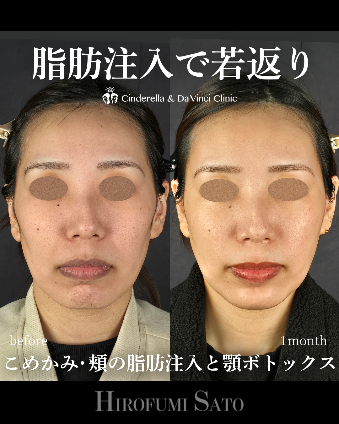 頬コケの脂肪注入