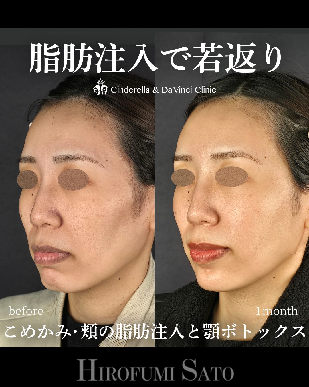 頬コケの脂肪注入の画像