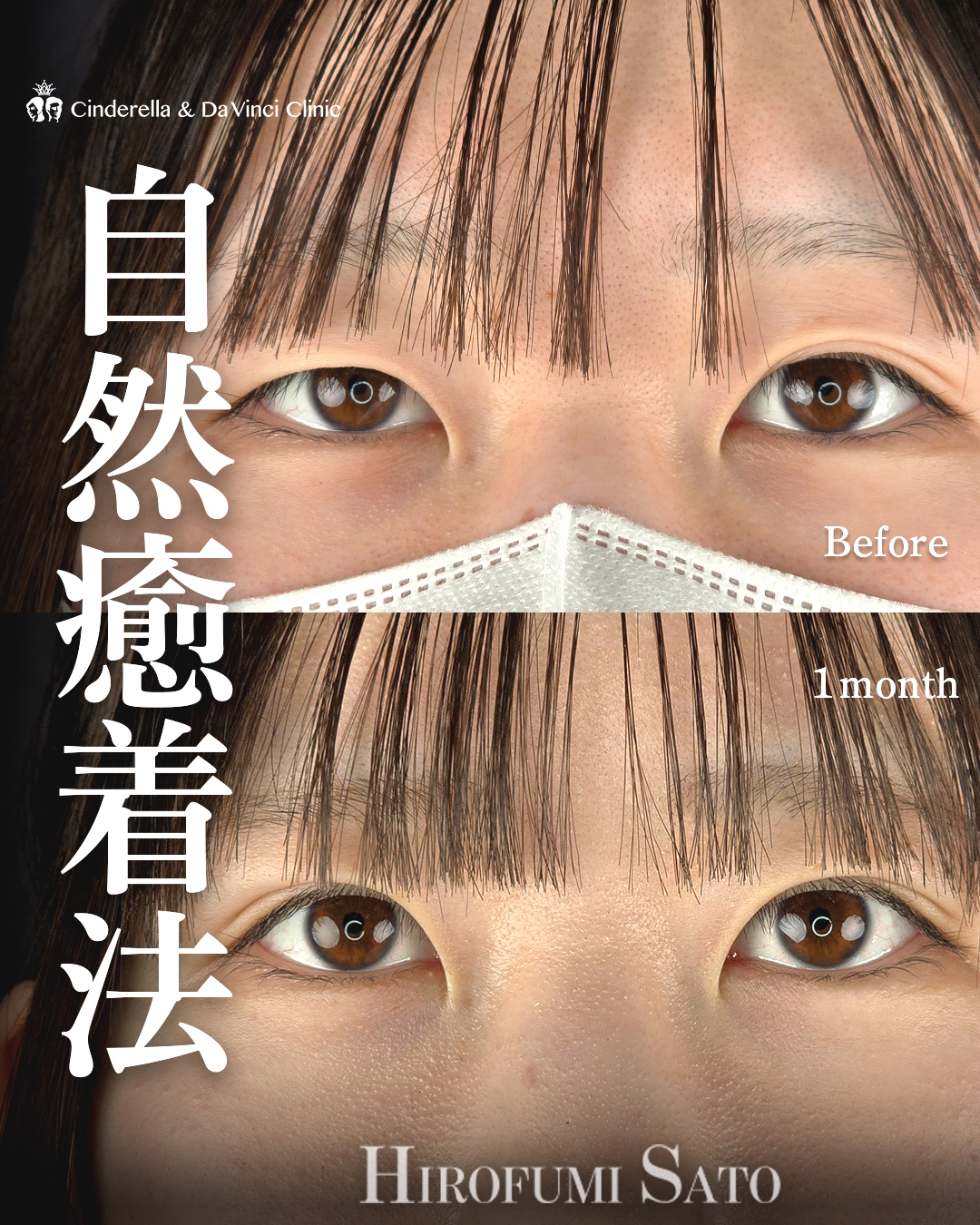 二重の左右差をなおす