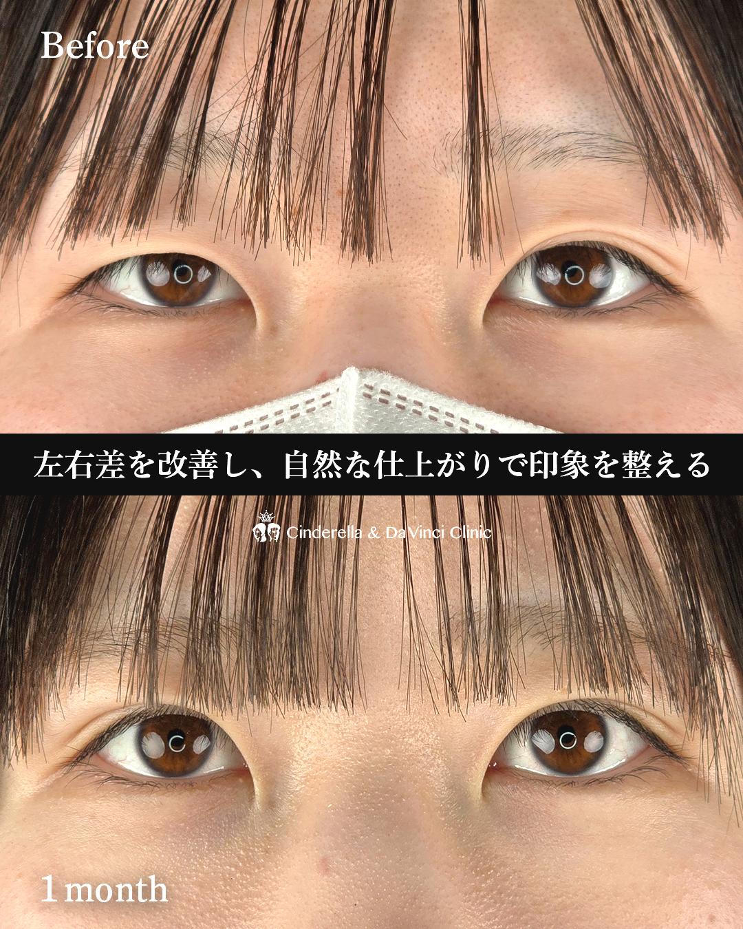 二重の左右差をなおすの画像