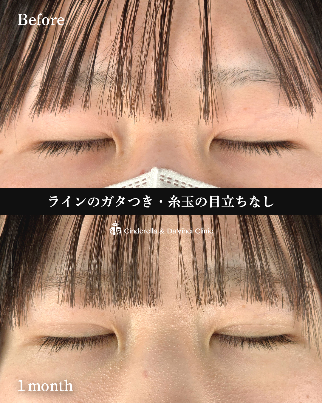 二重の左右差をなおすの画像