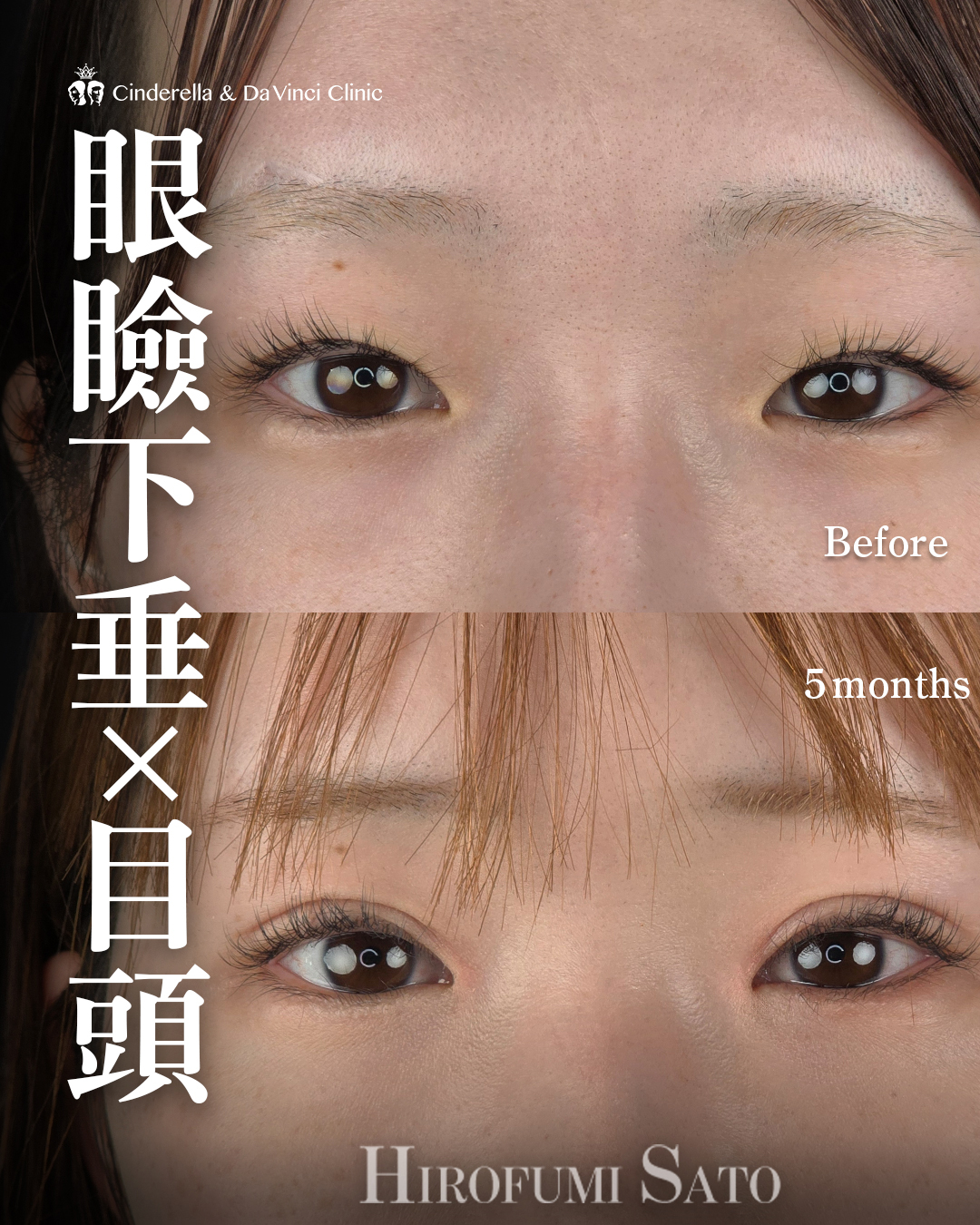 目を大きくする