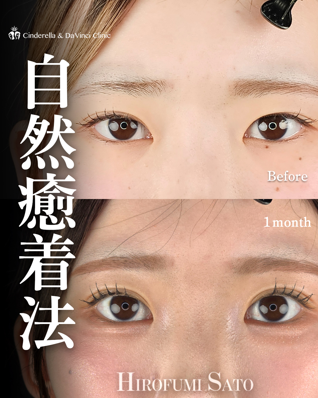 自然癒着で目を大きく