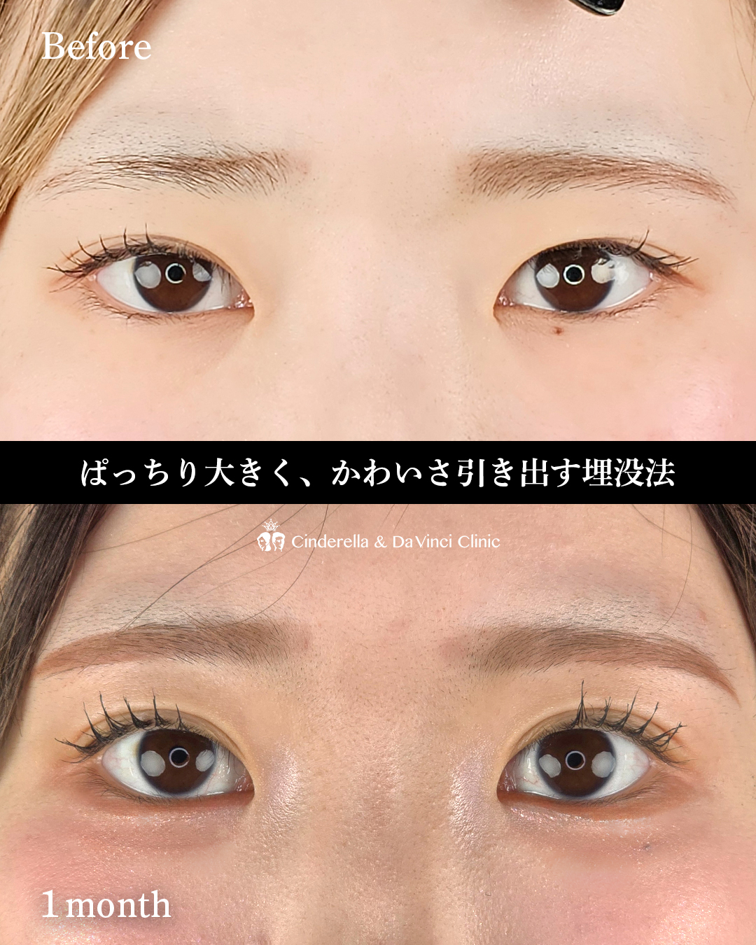 自然癒着で目を大きくの画像