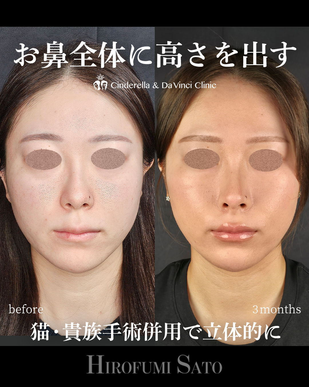 鼻を全体的に高くの画像