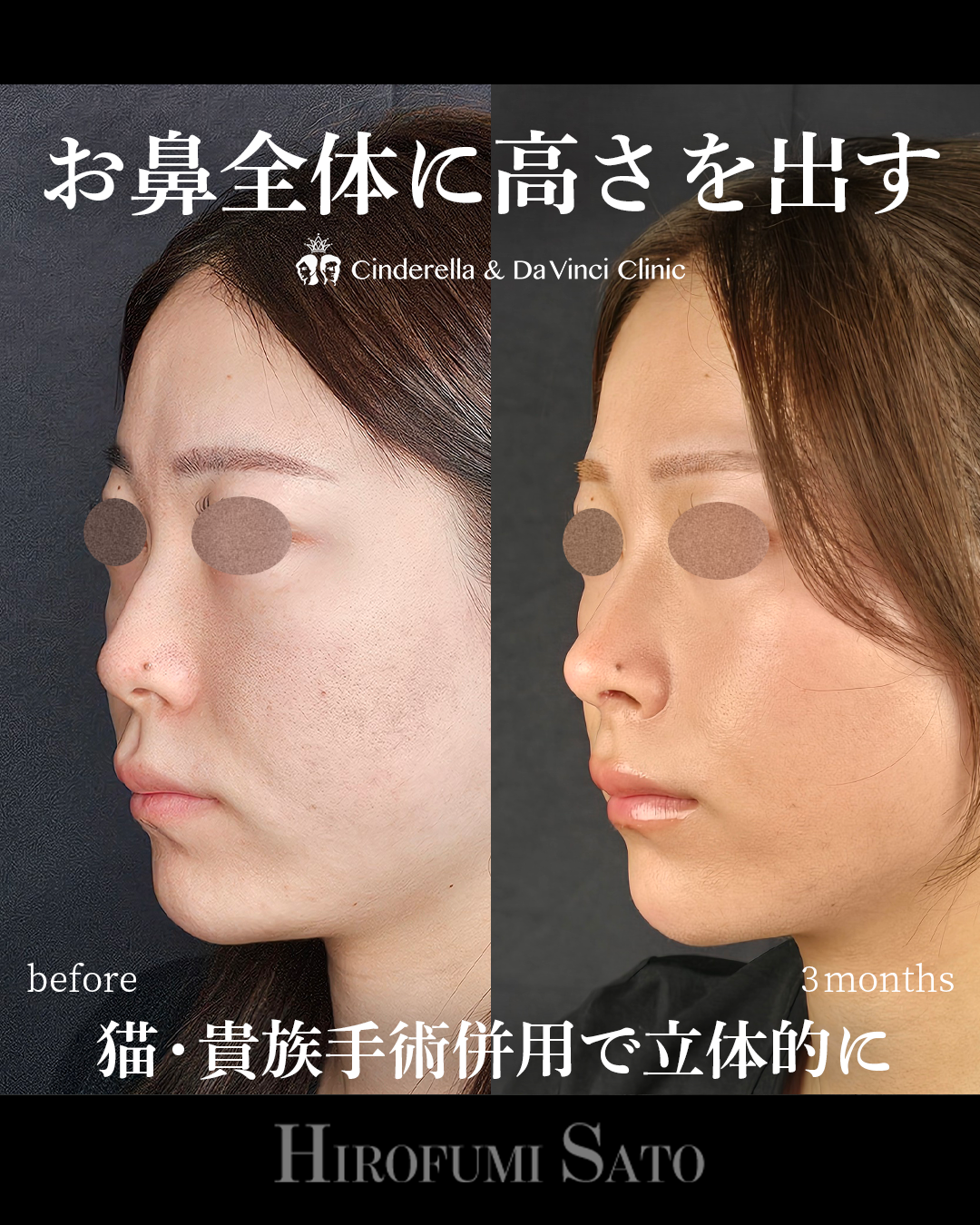 鼻を全体的に高くの画像