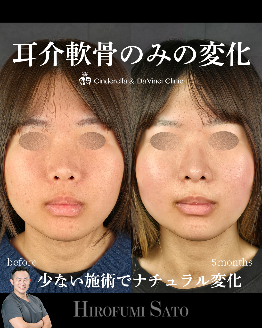 少ない施術でナチュラルアプデの画像